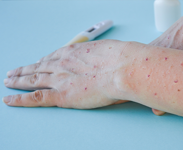 Signos y síntomas de la viruela del mono